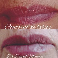 Relleno de labios - Dr. David Villagra