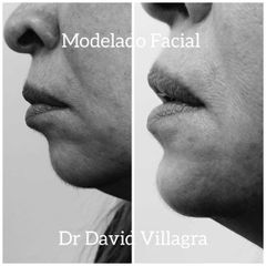 Modelación Facial - Dr. David Villagra