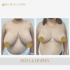 Reducción mamas - Dra. Micaela Taverna