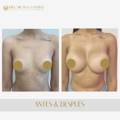 Aumento mamas  - Dra. Micaela Taverna