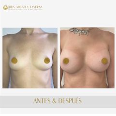 Aumento mamas  - Dra. Micaela Taverna