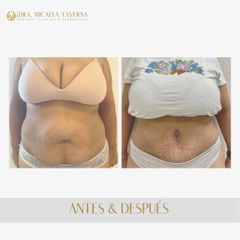 Abdominoplastia - Dra. Micaela Taverna