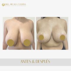 Reducción mamas - Dra. Micaela Taverna