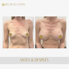 Aumento mamas  - Dra. Micaela Taverna