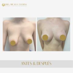 Aumento mamas - Dra. Micaela Taverna