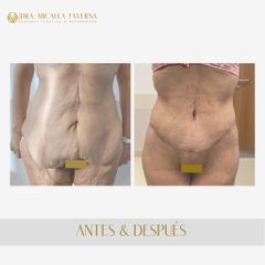 Abdominoplastia - Dra. Micaela Taverna