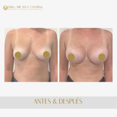 Aumento mamas  - Dra. Micaela Taverna