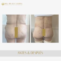 Liposucción - Dra. Micaela Taverna