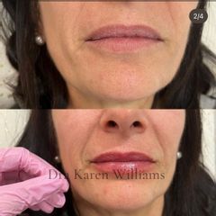 Relleno de labios - Dra. Karen Eliana Williams