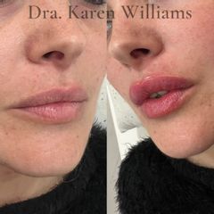Relleno de labios - Dra. Karen Eliana Williams