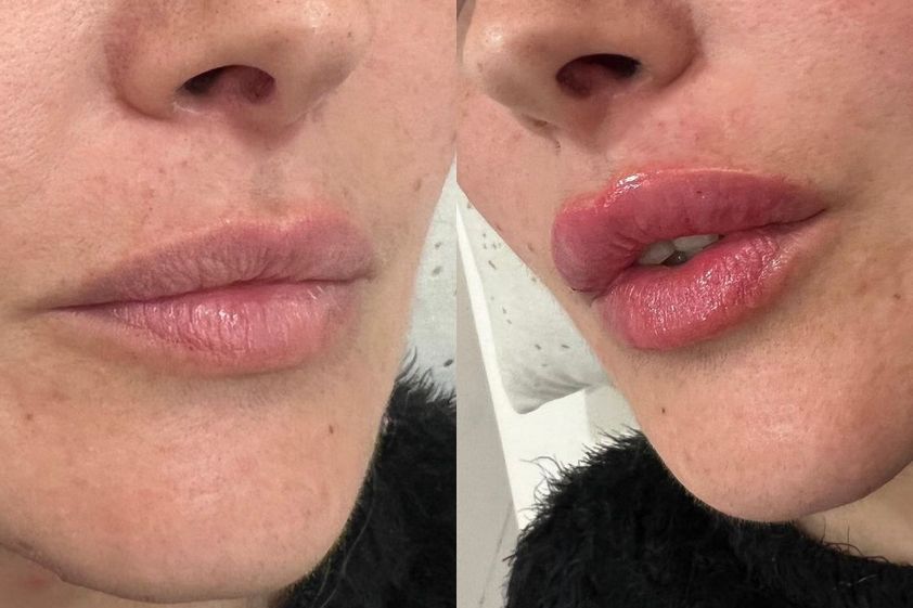 Relleno de labios antes y después - 850363