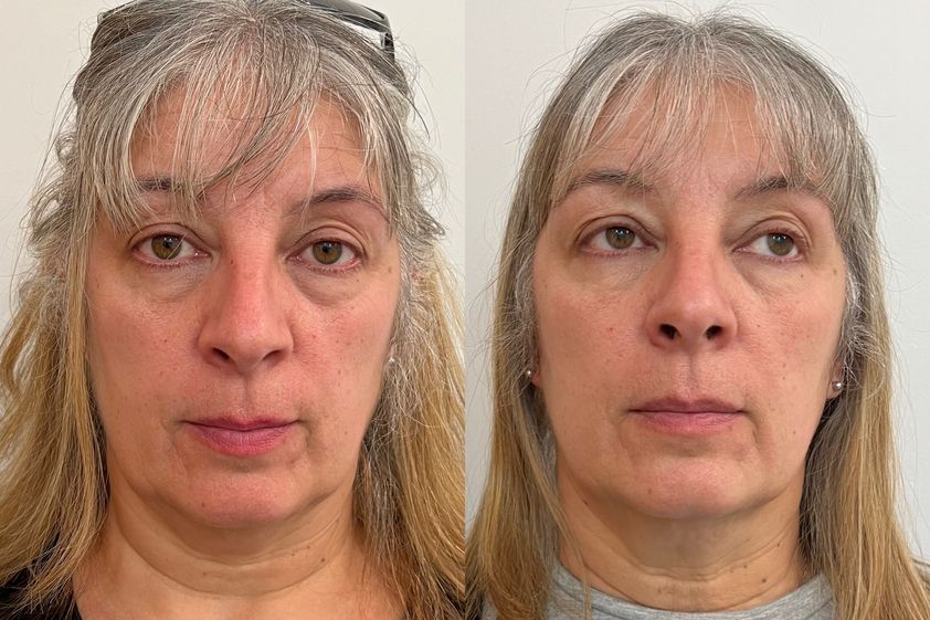 Rejuvenecimiento facial antes y después - 850621