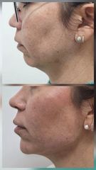 Endolifting facial: reducción de papada, antes y después