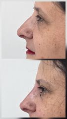 Rinomodelación con ácido hialurónico - Alma Estética - Dra. Mariela Orgueira