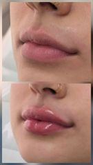 Labios con ácido hialurónico - Alma Estética - Dra. Mariela Orgueira