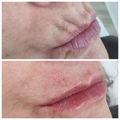 Hidratación y perfilado de labios maduros con ácido hialurónico - Alma Estética - Dra. Mariela Orgue