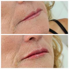 Arrugas peribucales (código de barras) y labios - Alma Estética - Dra. Mariela Orgueira