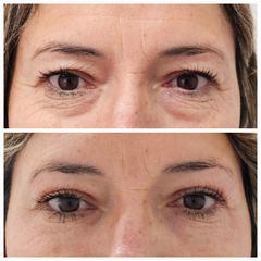 Contorno de ojos y patas de gallo - Alma Estética - Dra. Mariela Orgueira