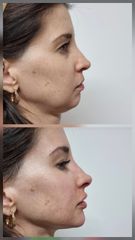 Definición del óvalo facial y línea mandibula - Alma Estética - Dra. Mariela Orgueira