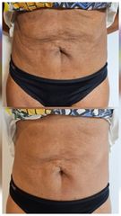 Flacidez abdominal - Alma Estética - Dra. Mariela Orgueira