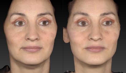 Diagnóstico facial 3D con Vectra H2: simulación de resultados - Alma Estética - Dra. Mariela Orgueir