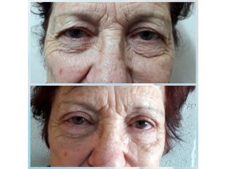 Blefaroplastia