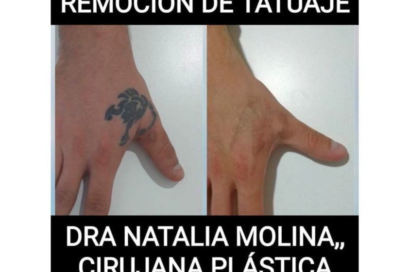 Borrar tatuajes antes y después - 640344