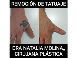 Eliminación de tatuaje