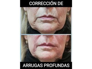 Corrección de arrugas