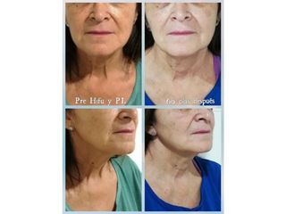 Hifu facial