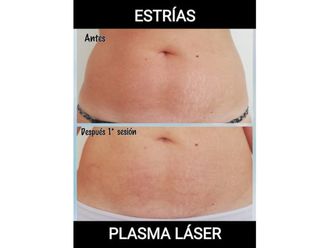 Tratamientos para estrías antes y después - 640349