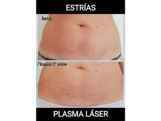 Plasma láser