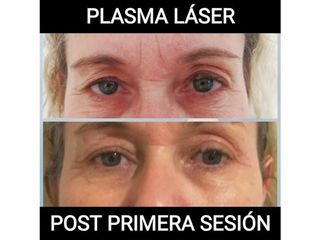 Plasma láser