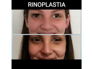 Rinoplastia