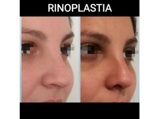 Rinoplastia