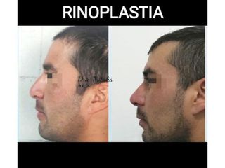 Rinoplastia