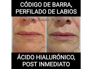 Perfilado de labios con ácido hialurónico