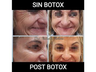 Botox