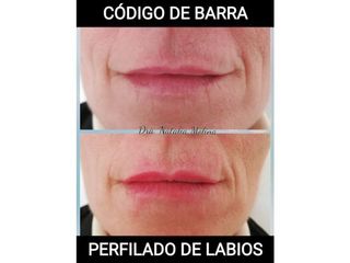 Perfilado de labios 