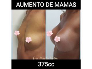Aumento de mamas