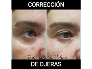 Corrección de ojeras