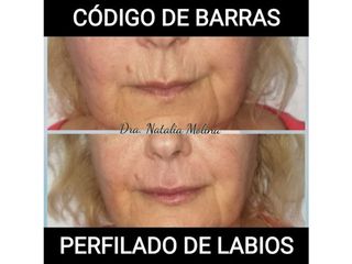 Perfilado de labios 