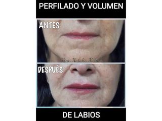 Perfilado y volumen de labios