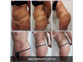 Abdominoplastia