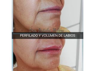 Perfilado y volumen de labios