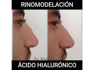 Rinomodelación con ácido hialurónico