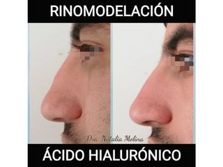 Rinomodelación con ácido hialurónico