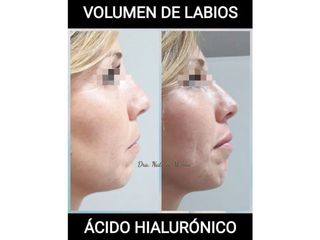 Volumen de labios con ácido hialurónico