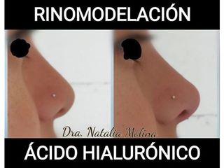 Rinomodelación con ácido hialurónico