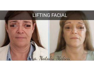 Lifting facial